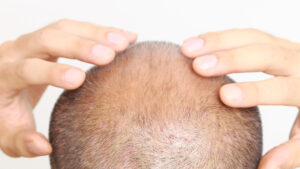 Hair Loss